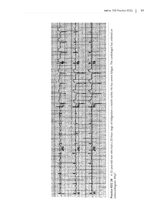 part ii: 150 Practice ECGs 89
Practice
ECG
26
A
52-year-old
man
who
had
a
20-hour
siege
of
indigestion
a
month
earlier.
He
has
severe
fatigue.
The
cardiologist
has
ordered
an
echocardiogram.
Why?
 