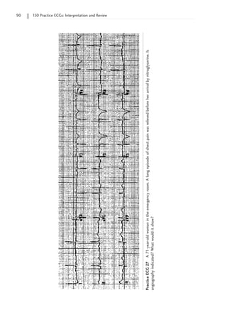 90 150 Practice ECGs: Interpretation and Review
Practice
ECG
27
A
71-year-old
woman
in
the
emergency
room.
A
long
episode
of
chest
pain
was
relieved
before
her
arrival
by
nitroglycerine.
Is
angiography
indicated?
What
would
it
show?
 