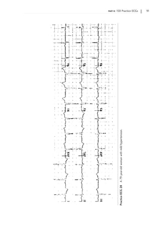 part ii: 150 Practice ECGs 91
Practice
ECG
28
A
79-year-old
woman
with
mild
hypertension.
 