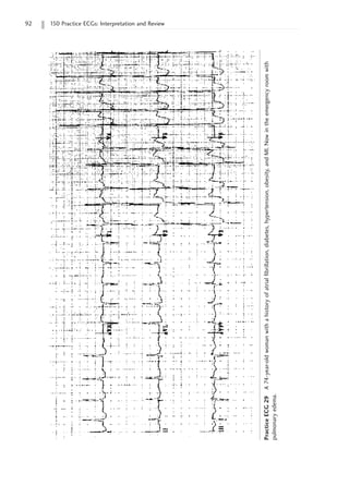 92 150 Practice ECGs: Interpretation and Review
Practice
ECG
29
A
74-year-old
woman
with
a
history
of
atrial
fibrillation,
diabetes,
hypertension,
obesity,
and
MI.
Now
in
the
emergency
room
with
pulmonary
edema.
 