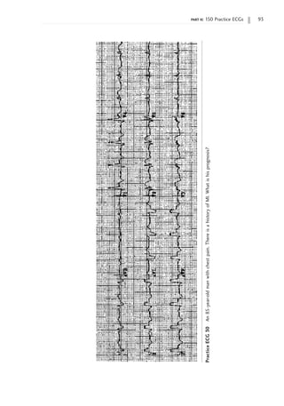 part ii: 150 Practice ECGs 93
Practice
ECG
30
An
85-year-old
man
with
chest
pain.
There
is
a
history
of
MI.
What
is
his
prognosis?
 