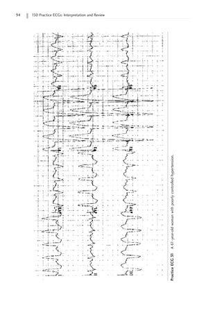 94 150 Practice ECGs: Interpretation and Review
Practice
ECG
31
A
61-year-old
woman
with
poorly
controlled
hypertension.
 