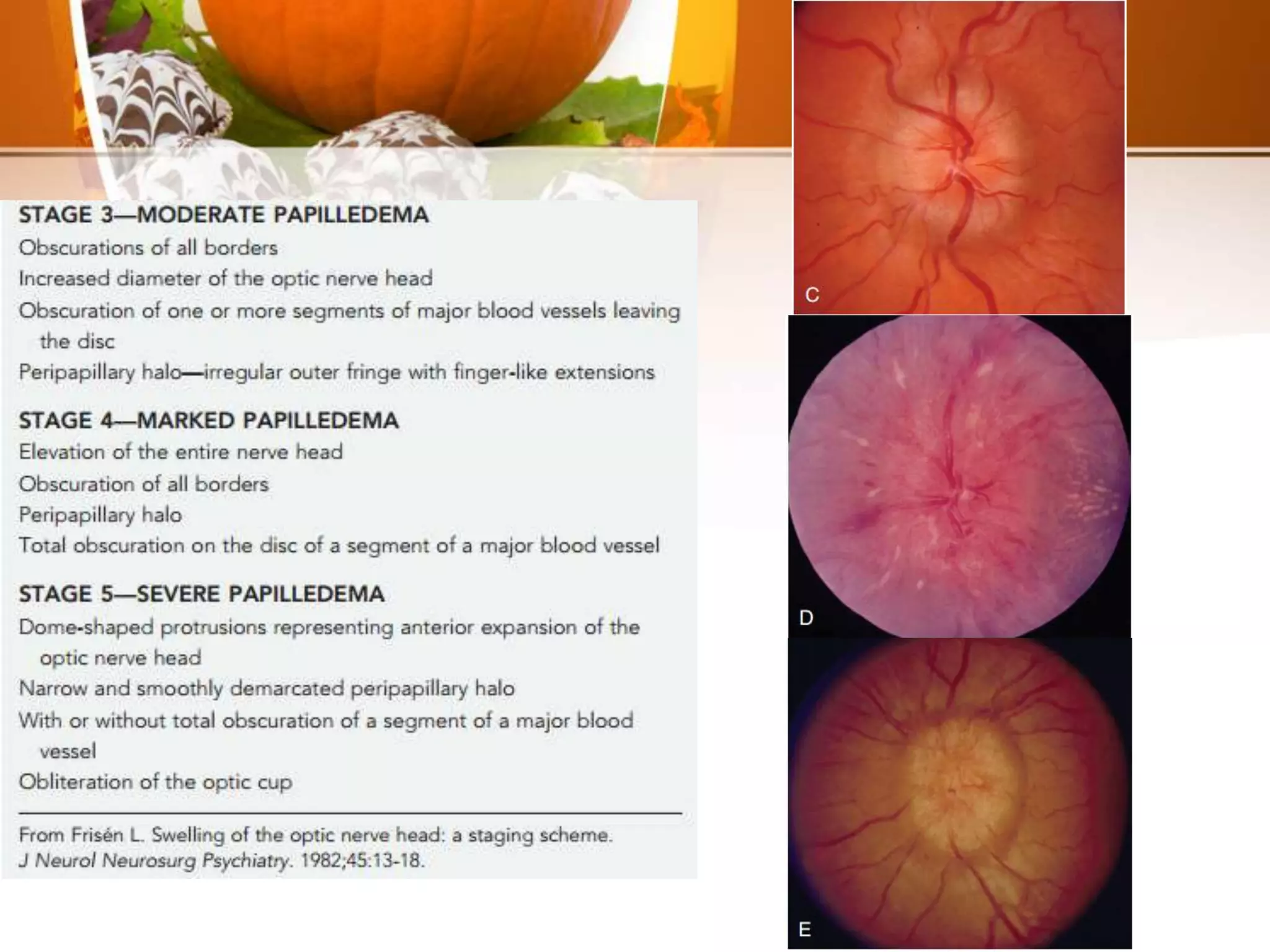 150 Pseudotumor cerebri | PPT