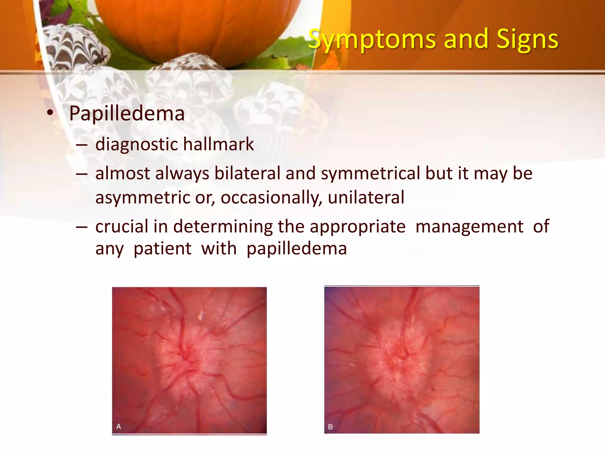 150 Pseudotumor cerebri | PPT