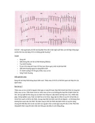 ECG107 : một người phụ nữ 50t vào bộ phận theo dõi vì đột ngột xuất hiện cơn hồi hộp trống ngực
và khó thở mức độ nặng. ECG có những gì bất thường ?
Trả lời
- Rung nhĩ
- QRS không đều với tần số thất khoảng 200ck/p
- Trục bình thường
- R cao ở V6 cộng với S sâu ở V2 lớn hơn 35mm gợi ý một cái phì đại thất
- QRS bình thường ngoại trừ dạng RSR ở AVF
- ST chênh xuống ở V4-V6 gợi ý thiếu máu cơ tim
- Sóng T bình thường
Diễn giải lâm sàng
Rung nhĩ với nhịp thất không được kiểm soát. Thiếu máu ở V4,V5 có thể liên quan với nhip tim của
bệnh nhân .
Bạn làm gì ?
Thiếu máu cơ tim có thể là nguyên nhân gây ra rung nhĩ hoặc nhịp thất nhanh bản thân nó cũng làm
thiếu máu cơ tim. Chẩn đoán chính là thiếu máu cơ tim có vẻ không phù hợp lắm ở bệnh nhân nữ
50t, cần suy nghĩ về khả năng của các bệnh như thấp tim ( đặc biệt là với hẹp van 2 lá ), nhiễm độc
giáp, chứng nghiện rượu, hoặc các bệnh lý cơ tim khác. Ngay lập tức điều trị suy tim với lợi tiểu và
nitrat tĩnh mạch có thể là cần thiết, nhưng nhịp thất cần kiểm soát tốt với digoxin , có thể dùng theo
đường tĩnh mach nếu cần thiết. Sốc điện cũng có thể cần thiết nếu bệnh nhân có suy tim nặng ,
nhưng tốt nhất đầu tiên là nên xác định các nguyên nhân cơ bản gây rung nhĩ nếu có thể. Phải nhớ
rằng bệnh nhân rung nhĩ chắc chắn cần thời gian dài điều trị với chống đông.
 