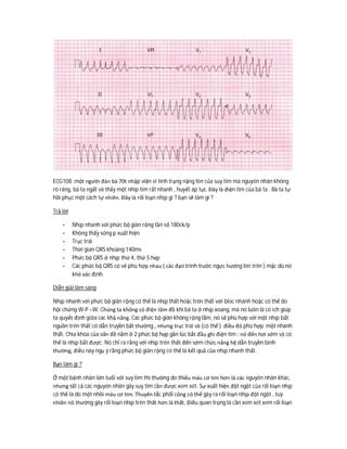 ECG108 :một người đàn bà 70t nhập viện vì tình trạng nặng lên của suy tim mà nguyên nhân không
rõ ràng, bà ta ngất và thấy một nhip tim rất nhanh , huyết áp tụt. Đây là điện tim của bà ta . Bà ta tự
hồi phục một cách tự nhiên. Đây là rối loạn nhịp gì ? bạn sẽ làm gì ?
Trả lời
- Nhịp nhanh với phức bộ giãn rộng tần số 180ck/p
- Không thấy sóng p xuất hiện
- Trục trái
- Thời gian QRS khoảng 140ms
- Phức bộ QRS ở nhịp thứ 4, thứ 5 hẹp
- Các phức bộ QRS có vẻ phù hợp nhau ( các đạo trình trước ngực hướng lên trên ) mặc dù nó
khó xác định.
Diễn giải lâm sàng
Nhịp nhanh với phức bộ giãn rộng có thể là nhịp thất hoặc trên thất với bloc nhánh hoặc có thể do
hội chứng W-P –W. Chúng ta không có điện tâm đồ khi bà ta ở nhịp xoang, mà nó luôn là có ich giúp
ta quyết định giữa các khả năng. Các phức bộ giãn không rộng lắm, nó sẽ phù hợp với một nhịp bắt
nguồn trên thất có dẫn truyền bất thường , nhưng trục trái và (có thế ) điều đó phù hợp một nhanh
thất. Chìa khóa của vấn đề nằm ở 2 phức bộ hẹp gần lúc bắt đầu ghi điện tim : nó đến hơi sớm và có
thể là nhịp bắt được. Nó chỉ ra rằng với nhịp trên thất đến sớm chức năng hệ dẫn truyền bình
thường, điều này ngụ ý rằng phức bộ giãn rộng có thể là kết quả của nhịp nhanh thất.
Bạn làm gì ?
Ở một bệnh nhân lớn tuổi với suy tim thì thường do thiếu máu cơ tim hơn là các nguyên nhân khác,
nhưng tất cả các nguyên nhân gây suy tim cần được xem xét. Sự xuất hiện đột ngột của rối loạn nhịp
có thể là do một nhồi máu cơ tim. Thuyên tắc phổi cũng có thể gây ra rối loạn nhịp đột ngột , tuy
nhiên nó thường gây rối loạn nhịp trên thất hơn là thất. Điều quan trọng là cần xem xét xem rối loạn
 