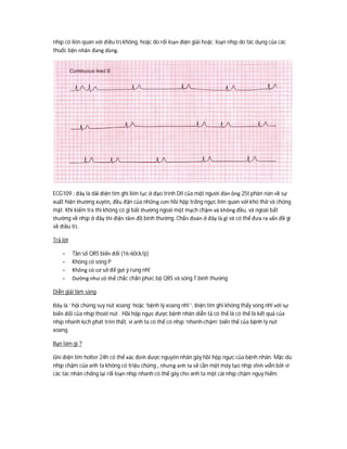 nhịp có liên quan với điều trị không, hoặc do rối loạn điện giải hoặc loạn nhịp do tác dụng của các
thuốc bện nhân đang dùng.
ECG109 : đây là dải điện tim ghi liên tục ở đạo trình DII của một người đàn ông 25t phàn nàn về sự
xuất hiện thường xuyên, đều đặn của những cơn hồi hộp trống ngực liên quan với khó thở và chóng
mặt. Khi kiểm tra thì không có gì bất thường ngoài một mạch chậm và không đều, và ngoài bất
thường về nhịp ở đây thì điện tâm đồ bình thường. Chẩn đoán ở đây là gì và có thể đưa ra vấn đề gì
về điều trị.
Trả lời
- Tần số QRS biến đổi (16-60ck/p)
- Không có sóng P
- Không có cơ sở để gợi ý rung nhĩ
- Dường như có thể chắc chắn phức bộ QRS và sóng T bình thường
Diễn giải lâm sàng
Đây là ‘ hội chứng suy nút xoang’ hoặc ‘bệnh lý xoang nhĩ ‘. Điện tim ghi không thấy sóng nhĩ với sự
biến đổi của nhịp thoát nút . Hồi hộp ngực được bệnh nhân diễn tả có thể là có thể là kết quả của
nhịp nhanh kịch phát trên thất, vì anh ta có thể có nhịp ‘nhanh-chậm’ biến thể của bệnh lý nút
xoang.
Bạn làm gì ?
Ghi điện tim holter 24h có thể xác định được nguyên nhân gây hồi hộp ngực của bệnh nhân. Mặc dù
nhịp chậm của anh ta không có triệu chứng , nhưng anh ta sẽ cần một máy tạo nhịp vĩnh viễn bởi vì
các tác nhân chống lại rối loạn nhịp nhanh có thể gây cho anh ta một cái nhịp chậm nguy hiểm.
 