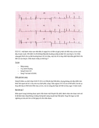 ECG112 : một bệnh nhân nam 40t điều trị ngoại trú có tiền sử gợi ý một cái nhồi máu cơ tim cách
đây 3 tuần trước. Khi kiểm tra thì không thấy bất thường và đây là điện tim của ông ta. Có 2 khả
năng giải thích cho sự bất thường được chỉ ra ở đây, mặc dù chỉ có duy nhất một điều giải thích cho
tiền sử của ông ta. Chẩn đoán ở đây có thể là gì ?
Trả lời
- Nhịp xoang
- Trục bình thường
- Sóng R trội ở V1
- Sóng T hơi dẹt ở DI,AVL
Diễn giải lâm sàng
Sóng R chiếm ưu thế ở đạo trình V1 chỉ ra có thể phì đại thất phải, nhưng không còn đặc điểm nào
khác liên quan với nó ví dụ như trục lệch phải, sóng T đảo ngược ở V1,V2 và có thể lafV3. Do đó sự
thay đổi này có thể là do nhồi máu cơ tim, mà nó cũng phù hợp với tiền sử đau ngực 3 tuần trước.
Bạn làm gì ?
Điều quan trọng là không được quên chẩn đoán một thuyên tắc phổi. Bênh nhân nên được xem xét
kĩ để đảm bảo rằng không có bằng chứng lâm sàng của phì đại thất phải. Chụp XQ ngực tư thế
nghiêng và siêu âm tim có thể giúp ích cho chẩn đoán.
 
