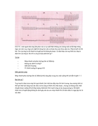 ECG115 : môt người đàn ông 50t phàn nàn vì sự xuất hiện những cơn chóng mặt và hồi hộp trống
ngực vài năm nay, ông ta bị ngất khi đang làm việc và được đua vào khoa cấp cứu. Ông ta lạnh vã mồ
hôi. Tim của ông ta rất nhanh và huyết áp thì không đo được. Có dấu hiệu của suy thất trái. Đây là
điện tim của ông ta. Nó chỉ ra cái gì và bạn phải làm gì ?
Trả lời
- Nhịp nhanh với phức bộ hẹp tần số 300ck/p
- Không xác định rõ sóng P
- QRS bình thường
- ST chênh xuống đi ngang ở V5
Diễn giải lâm sàng
Nhịp nhanh phức bộ hẹp tần số 300ck/p khả năng đặc trưng cho một cuồng nhĩ với dẫn truyền 1 :1.
Bạn làm gì ?
Trụy mạch ở đây là do nhịp tim quá nhanh, làm mất làm đầy máu thì tâm trương. Xoa xoang cảnh có
thể tạm thời làm tăng mức độ bloc và nó củng có thêm cho chẩn đoán , nhưng nó không chắc chắn
chuyển được cuồng nhĩ về nhịp xoang. Adenosin tĩnh mạch cũng có tác dụng tương tự. Khi bệnh
nhân mà có huyết động không ổn định gây nên do cơn nhịp nhanh thì chỉ định điều trị ngay lập tức là
sốc điện.
 