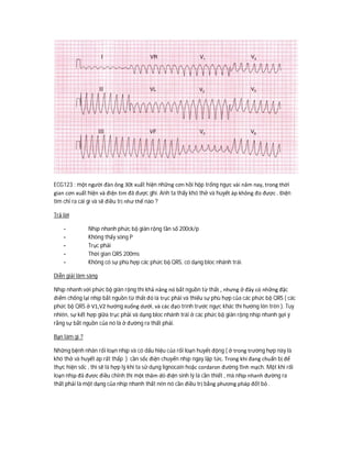 ECG123 : một người đàn ông 30t xuất hiện những cơn hồi hộp trống ngực vài năm nay, trong thời
gian cơn xuất hiện và điện tim đã được ghi. Anh ta thấy khó thở và huyết áp không đo được . Điện
tim chỉ ra cái gì và sẽ điều trị như thế nào ?
Trả lời
- Nhịp nhanh phức bộ giãn rộng tần số 200ck/p
- Không thấy sóng P
- Trục phải
- Thời gian QRS 200ms
- Không có sự phù hợp các phức bộ QRS, có dạng bloc nhánh trái.
Diễn giải lâm sàng
Nhịp nhanh với phức bộ giãn rộng thì khả năng nó bắt nguồn từ thất , nhưng ở đây có những đặc
điểm chống lại nhịp bắt nguồn từ thất đó là trục phải và thiếu sự phù hợp của các phức bộ QRS ( các
phức bộ QRS ở V1,V2 hướng xuống dưới, và các đạo trình trước ngực khác thì hướng lên trên ). Tuy
nhiên, sự kết hợp giữa trục phải và dạng bloc nhánh trái ở các phức bộ giãn rộng nhịp nhanh gợi ý
rằng sự bắt nguồn của nó là ở đường ra thất phải.
Bạn làm gì ?
Những bệnh nhân rối loạn nhịp và có dấu hiệu của rối loạn huyết động ( ở trong trường hợp này là
khó thở và huyết áp rất thấp ) cần sốc điện chuyển nhịp ngay lập tức. Trong khi đang chuẩn bị để
thực hiện sốc , thì sẽ là hợp lý khi ta sử dụng lignocain hoặc cordaron đường tĩnh mạch. Một khi rối
loạn nhịp đã đươc điều chỉnh thì một thăm dò điện sinh lý là cần thiết , mà nhịp nhanh đường ra
thất phải là một dạng của nhịp nhanh thất nên nó cần điều trị bằng phương pháp đốt bỏ .
 