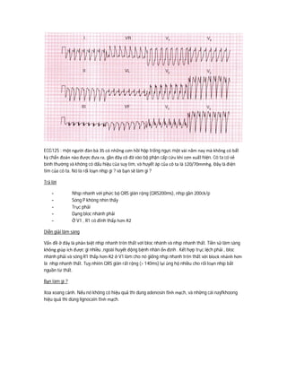ECG125 : một người đàn bà 35 có những cơn hồi hộp trống ngực một vài năm nay mà không có bất
kỳ chẩn đoán nào được đưa ra, gần đây cô đã vào bộ phận cấp cứu khi cơn xuất hiện. Cô ta có vẻ
bình thường và không có dấu hiệu của suy tim, và huyết áp của cô ta là 120/70mmhg. Đây là điện
tim của cô ta. Nó là rối loạn nhịp gì ? và bạn sẽ làm gì ?
Trả lời
- Nhịp nhanh với phức bộ QRS giãn rộng (QRS200ms), nhịp gần 200ck/p
- Sóng P không nhìn thấy
- Trục phải
- Dạng bloc nhánh phải
- Ở V1 , R1 có đỉnh thấp hơn R2
Diễn giải lâm sàng
Vấn đề ở đây là phân biệt nhịp nhanh trên thất với bloc nhánh và nhịp nhanh thất. Tiền sử lâm sàng
không giúp ích được gì nhiều ,ngoài huyết động bệnh nhân ổn định . Kết hợp trục lệch phải , bloc
nhánh phải và sóng R1 thấp hơn R2 ở V1 làm cho nó giống nhịp nhanh trên thất với block nhánh hơn
là nhịp nhanh thất. Tuy nhiên QRS giãn rất rộng (> 140ms) lại ủng hộ nhiều cho rối loạn nhịp bắt
nguồn từ thất.
Bạn làm gì ?
Xoa xoang cảnh. Nếu nó không có hiệu quả thì dùng adenosin tĩnh mạch, và những cái nayfkhoong
hiệu quả thì dùng lignocain tĩnh mạch.
 