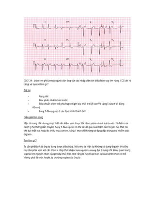 ECG134 : Điện tim ghi từ một người đàn ông 60t vào nhập viện với biểu hiện suy tim nặng. ECG chỉ ra
cái gì và bạn sẽ làm gì ?
Trả lời
- Rung nhĩ
- Bloc phân nhánh trái trước
- Tiêu chuẩn điện thế phù hợp với phì đại thất trái (R cao V6 cộng S sâu ở V1 bằng
40mm)
- Sóng T đảo ngược ở các đạo trình thành bên
Diễn giải lâm sàng
Mặc dù rung nhĩ nhưng nhịp thất vẫn kiểm soát được tốt. Bloc phân nhánh trái trước chỉ điểm của
bệnh lý hệ thống dẫn truyền. Sóng T đảo ngược có thể là kết quả của chậm dẫn truyền nội thất do
phì đại thất trái hoặc do thiếu máu cơ tim. Sóng T thay đổi không có dạng đặc trưng cho nhiễm độc
digoxin .
Bạn làm gì ?
Ta cần phải biết là ông ta đang được điều trị gì. Nếu ông ta hiện tại không sử dung digoxin thì điều
này cần phải xem xét cẩn thận vì nhịp thất chậm hơn người ta mong đợi ở rung nhĩ. Điều quan trọng
là phải tìm nguyên nhân của phì đại thất trái, nhớ rằng là huyết áp hiện tại của bệnh nhân có thể
không phải là mức huyết áp thường xuyên của ông ta .
 