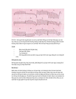 ECG135 : một người đàn ông 60t phàn nàn về sự xuất hiện những cơn hồi hộp trống ngực vài năm
nay. Giữa các cơn thì ông vẫn bình thường, không có dấu hiệu thực thể bất thường,và điện tim bình
thường. Đây là điện tim ghi trong khi cơn xuất hiện. Nó là rối loạn nhịp gì và bạn phải làm gì ?
Trả lời
- Nhịp nhanh đều phức bộ giãn rộng
- Thời gian QRS 160ms
- Trục hướng trái
- Hình dạng QRS là khó xác định, hưng các đạo trình trước ngực đồng âm và có dang QS
ở V6.
Diễn giải lâm sàng
Kết hợp phức bộ giãn rộng ,nhịp nhanh đều, QRS đồng âm ở các đạo trình trước ngực và dạng QS ở
V6 là đặc trưng của nhịp nhanh thất.
Bạn làm gì ?
Bệnh nhân chỉ thỉnh thoảng có những cơn rối lọan nhịp, còn những lúc khác thì hoàn toàn bình
thường,vì vậy sẽ là rất khó cho việc quản lý rối loạn nhịp của ông ta. Bệnh nhân này nên được làm
siêu âm tim để loại trù bệnh cơ tim phì đại, và một test gắng sức để loại trừ thiếu máu cơ tim và loại
trừ rối loạn nhị khi gắng sức. Ở tuổi 60 chụp mạch vành có thể phải chỉ định. Điều trị với amidaron là
hiệu quả như một tác nhân chống loạn nhịp trên cơ sở lặp lại các thăm dò điện sinh lý. Nếu các cơn
xuất hiện mà gây ngất thì cấy một máy khử rung là cần phải xem xét.
 