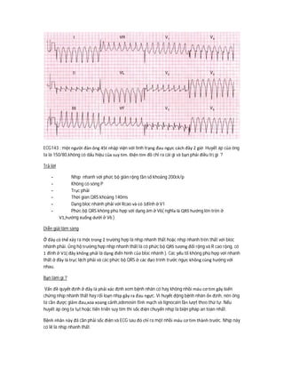 ECG143 : một người đàn ông 45t nhập viện với tình trạng đau ngực cách đây 2 giờ. Huyết áp của ông
ta là 150/80,không có dấu hiệu của suy tim. Điện tim đồ chỉ ra cái gì và bạn phải điều trị gì ?
Trả lời
- Nhịp nhanh với phức bộ giãn rộng tần số khoảng 200ck/p
- Không có sóng P
- Trục phải
- Thời gian QRS khoảng 140ms
- Dạng bloc nhánh phải với Rcao và có 1đỉnh ở V1
- Phức bộ QRS không phù hợp với dạng âm ở V6( nghĩa là QRS hướng lên trên ở
V1,hướng xuống dưới ở V6 )
Diễn giải lâm sàng
Ở đây có thể xảy ra một trong 2 trường hợp là nhịp nhanh thất hoặc nhịp nhanh trên thất với bloc
nhánh phải. Ủng hộ trường hợp nhịp nhanh thất là có phức bộ QRS tương đối rộng và R cao rộng, có
1 đỉnh ở V1( đây không phải là dạng điển hình của bloc nhánh ). Các yếu tố không phù hợp với nhanh
thất ở đây là trục lệch phải và các phức bộ QRS ở các đạo trình trước ngực không cùng hướng với
nhau.
Bạn làm gì ?
Vấn đề quyết định ở đây là phải xác định xem bệnh nhân có hay không nhồi máu cơ tim gây biến
chứng nhịp nhanh thất hay rối loạn nhịp gây ra đau ngực. Vì huyết động bệnh nhân ổn định, nên ông
ta cần được giảm đau,xoa xoang cảnh,adenosin tĩnh mạch và lignocain lần lượt theo thứ tự. Nếu
huyết áp ông ta tụt hoặc tiến triển suy tim thì sốc điện chuyển nhịp là biện pháp an toàn nhất.
Bệnh nhân này đã cần phải sốc điện và ECG sau đó chỉ ra một nhồi máu cơ tim thành trước. Nhịp này
có lẽ là nhịp nhanh thất.
 