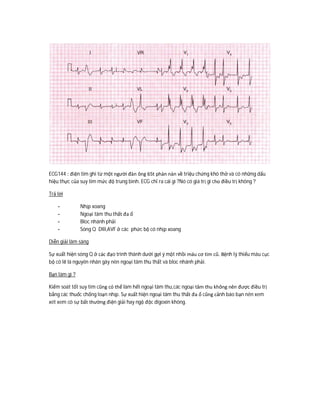 ECG144 : điện tim ghi từ một người đàn ông 65t phàn nàn về triệu chứng khó thở và có những dấu
hiệu thực của suy tim mức độ trung bình. ECG chỉ ra cái gì ?Nó có giá trị gì cho điều trị không ?
Trả lời
- Nhịp xoang
- Ngoại tâm thu thất đa ổ
- Bloc nhánh phải
- Sóng Q DIII,AVF ở các phức bộ có nhịp xoang
Diễn giải lâm sàng
Sự xuất hiện sóng Q ở các đạo trình thành dưới gợi ý một nhồi máu cơ tim cũ. Bệnh lý thiếu máu cục
bộ có lẽ là nguyên nhân gây nên ngoại tâm thu thất và bloc nhánh phải.
Bạn làm gì ?
Kiểm soát tốt suy tim cũng có thể làm hết ngoại tâm thu,các ngoại tâm thu không nên được điều trị
bằng các thuốc chống loạn nhịp. Sự xuất hiện ngoại tâm thu thất đa ổ cũng cảnh báo bạn nên xem
xét xem có sự bất thường điện giải hay ngộ độc digoxin không.
 