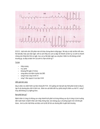 ECG15 : một sinh viên 20t phàn nàn về triệu chứng đánh trống ngực. Nó xảy ra một vài lần mỗi năm.
Nó bắt đầu một cách đột ngột anh ta cảm thấy tim anh ta đập rất nhanh và liên tục và anh ta nhanh
chóng cảm thấy khó thở và ngất. Cơn nó tự hết đột ngột sau vài phút. Kiểm tra thì không có bất
thường gì, và đây là điện tim của anh ta. Bạn sẽ làm gì ?
Trả lời
- nhịp xoang
- trục phải
- khoảng PR ngắn (112ms)
- sóng delta trát đậm ở phức bộ QRS
- sóng R trội ở đạo trình V1
- sóng T đảo ngược ở các đạo trình
diễn giải lâm sàng
Đây là điên tim điển hình của hội chứng W-P-W . ECG giống với một phì đại thất phải là bởi vì đây là
typ A với đường phụ nằm ở bên trái . Điên tim với biến đổi trục phải,sóng R chiếm ưu thế V1, song T
thay đổi không có ý nghĩa gì hơn.
Bạn phải làm gì ?
Bệnh nhân rõ ràng có những cơn nhịp nhanh kịch phát và trong những cơn ấy rõ ràng có ảnh hưởng
đến tuần hoàn vì bệnh nhân cảm thấy chóng mặt. Cơn không xảy ra thường xuyên nên rất khó ghi
đươc . Anh ta cần một khảo sát điện sinh lý để cắt bỏ các đường dẫn truyền bất thường.
 