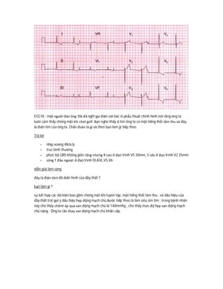 ECG18 : một người đàn ông 70t đã nghỉ gọi điện với bác sĩ phẫu thuật chỉnh hình nói rằng ông ta
luôn cảm thấy chóng mặt khi chơi golf. Bạn nghe thấy ở tim ông ta có một tiếng thổi tâm thu và đây
là điện tim của ông ta. Chẩn đoán là gì và theo bạn làm gì tiếp theo.
Trả lời
- nhịp xoang 48ck/p
- truc bình thường
- phức bộ QRS không giãn rộng nhưng R cao ở đạo trình V5 30mm, S sâu ở đạo trình V2 25mm
- sóng T đảo ngược ở đạo trình DI,AVL,V5,V6
diễn giải lâm sàng
đây là điện tâm đồ điển hình của dầy thất T
bạn làm gì ?
sự kết hợp các dữ kiện bao gồm chóng mặt khi luyên tâp, một tiếng thổi tâm thu , và dấu hiệu của
dầy thất trái gợi ý dấu hiệu hẹp động mạch chủ.Bước tiếp theo là làm siêu âm tim : trong bệnh nhân
này cho thấy chênh áp qua van động mạch chủ là 140mmhg , cho thấy mức độ hẹp van động mạch
chủ nặng . Ông ta cần thay van động mạch chủ khẩn cấp.
 