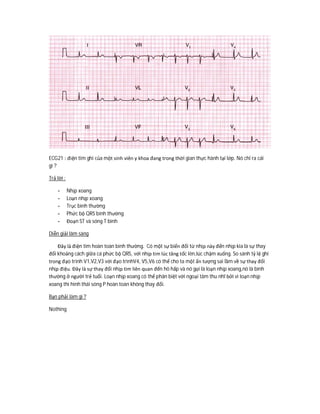 ECG21 : điện tim ghi của một sinh viên y khoa đang trong thời gian thực hành tại lớp. Nó chỉ ra cái
gì ?
Trả lời :
- Nhịp xoang
- Loạn nhịp xoang
- Trục bình thường
- Phức bộ QRS bình thường
- Đoạn ST và sóng T bình
Diễn giải lâm sàng
Đây là điện tim hoàn toàn bình thường. Có một sự biến đổi từ nhịp này đến nhịp kia là sự thay
đổi khoảng cách giữa cá phức bộ QRS, với nhịp tim lúc tăng tốc lên,lúc chậm xuống. So sánh tỷ lệ ghi
trong đạo trình V1,V2,V3 với đạo trìnhV4, V5,V6 có thể cho ta một ấn tượng sai lầm về sự thay đổi
nhịp điệu. Đây là sự thay đổi nhịp tim liên quan đến hô hấp và nó gọi là loạn nhịp xoang,nó là bình
thường ở người trẻ tuổi. Loạn nhịp xoang có thể phân biệt với ngoại tâm thu nhĩ bởi vì loạn nhịp
xoang thì hình thái sóng P hoàn toàn không thay đổi.
Bạn phải làm gì ?
Nothing
 