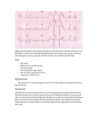 ECG23 : điện tâm đồ ghi ở một người đàn ông 70t có cái đau thắt ngực trong một vài thời gian và đã
được điều trị với bloc beta. Ông ta đến phòng khám phàn nàn về cái đau ngực tương tự nhưng với
mức độ nặng hơn và liên tục trong 4h. Điện tim này chỉ ra cái gì và điềutrị gì là thích hợp.
Trả lời
- Nhịp xoang
- Ngoại tâm thu trên thất ( bộ nối )
- Trục bình thường
- Phức bộ QRS giãn rộng ( 140ms)
- Phức bộ QRS có dạng chữ M ở V4-V6
- T đảo ngược ở DI,AVL,V5,V6
Diễn giải lâm sàng
Điện tâm đồ chỉ ra nhịp xoang,ngoại tâm thu trên thất, bloc nhánh trái.không giải thích gì hơn ở
điện tâm đồ này.
Bạn phải làm gì
Nếu bệnh nhân có triêu chứng gợi ý nhồi máu cơ tim trong vòng 6h mà có block nhánh trái thì tan
huyết khối chỉ được đưa ra nếu bloc nhánh trái đó là mới. Ở bệnh nhân này tiền sử có cái đau thắt
ngực vì vậy điều đầu tiên cần làm là giảm đau cho ông ta và sau đó là tìm các ghi chép trước đây xem
liệu bloc nhánh trái đã có trước đây. Nếu điện tâm đồ trước đây đã có bloc nhánh trái thì tiêu sợi
huyết không được sử dụng và điều trị như một hội chứng vành cấp. ngoại tâm thu trên thất không
quan trọng.
 