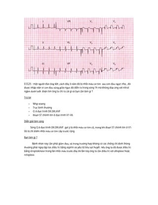 ECG25 : một người đàn ông 60t ,cách đây 3 năm đã bị nhồi máu cơ tim sau cơn đau ngực nhẹ , đã
được nhập viện vì cơn đau vùng giữa ngực đã diễn ra trong vòng 1h mà không đáp ứng với nitrat
ngậm dưới lưỡi .Điện tim ông ta chỉ ra cái gì và bạn cần làm gì ?
Trả lời
- Nhịp xoang
- Trục bình thường
- Q ở đạo trình DII,DIII,AVF
- Đoạn ST chênh lên ở đạo trình V1-V6
Diễn giải lâm sàng
Sóng Q ở đạo trình DII,DIII,AVF gợi ý là nhồi máu cơ tim cũ, trong khi đoạn ST chênh lên ở V1-
V6 là chỉ điểm nhồi máu cơ tim cấp trước rộng
Bạn làm gì ?
Bệnh nhân này cần phải giảm đau, và trong trường hợp không có các chống chỉ định thông
thường phải ngay lập tức điều trị bằng aspirin và yếu tố tiêu sợi huyết. nếu ông ta đã được điều trị
bằng streptokinase trong lần nhồi máu trước đây thì lần này ông ta cần điều trị với alteplase hoặc
reteplase.
 