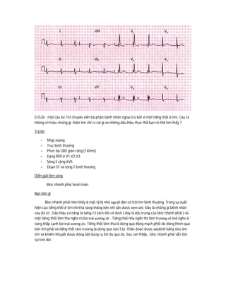 ECG26 : một cậu bé 15t chuyển đến bộ phận bệnh nhân ngoại trú bởi vì một tiếng thổi ở tim. Cậu ta
không có triệu chứng gì. Điện tim chỉ ra cái gì và những dấu hiệu thực thể bạn có thể tìm thấy ?
Trả lời
- Nhịp xoang
- Trục bình thường
- Phức bộ QRS giãn rộng (140ms)
- Dạng RSR ở V1,V2,V3
- Sóng S rộng ởV5
- Doạn ST và sóng T bình thường
Diễn giải lâm sàng
Bloc nhánh phải hoàn toàn
Bạn làm gì
Bloc nhánh phải nhìn thấy ở một tỷ lệ nhỏ người dân có trái tim bình thường. Trong sự xuất
hiện của tiếng thổi ở tim thì khả năng thông liên nhĩ cần đươc xem xét. Đây là những gì bệnh nhân
này đã có . Dấu hiệu cơ năng là tiếng T2 tách đôi cố định ( đây là đặc trưng của bloc nhánh phải ) và
một tiếng thổi tâm thu nghe rõ bờ trái xương ức . Tiếng thổi nhẹ ngắn thì tâm trương có thể nghe ở
vùng thấp cạnh bờ trái xương ức. Tiếng thổi tâm thu là dòng qua động mạch phổi do dòng thêm qua
bên tim phải và tiếng thổi tâm trương là dong qua van 3 lá. Chẩn đoán được xácđịnh bằng siêu âm
tim và khiếm khuyết được đóng bởi dụng cụ bít dù qua da. Sau can thiệp , bloc nhánh phải vẫn tồn
tại kéo dài.
 