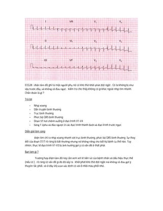 ECG28 : điện tâm đồ ghi từ một người phụ nữ có khó thở khởi phát đột ngột . Cô ta không bị như
vậy trước đây, và không có đau ngực . kiểm tra cho thấy không có gì khác ngoài nhịp tim nhanh.
Chẩn đoán là gì ?
Trả lời
- Nhịp xoang
- Dẫn truyền bình thường
- Trục bình thường
- Phức bộ QRS bình thường
- Doạn ST hơi chênh xuống ở đạo trình V1-V4
- Sóng T 2pha và đảo ngược ở các đạo trình thành dưới và đạo trình trước ngực
Diễn giải lâm sàng
Điện tim chỉ ra nhịp xoang nhanh với trục bình thường, phức bộ QRS bình thường .Sự thay
đổi của đoạn ST/T rõ ràng là bất thường nhưng nó không riêng cho bất kỳ bệnh cụ thể nào. Tuy
nhiên, thực tế đạo trình V1-V3 bị ảnh hưởng gợi ý có vấn đề ở thất phải.
Bạn làm gì ?
Trường hợp điện tâm đồ này cần xem xét kĩ tiền sử của bệnh nhân và dấu hiệu thực thể
(nếu có ) . rõ ràng có vấn đề gì đó đã xảy ra . khởi phát khó thở đột ngột mà không có đau gợi ý
thuyên tắc phổi, và ở đây VQ scan xác định có vài ổ nhồi máu phổi nhỏ .
 