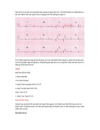 hiện ở tất cả các phụ nữ mang thai,nhịp xoang có ngoai tâm thu - Tốt nhất là kiềm tra tiếng thổi sau
khi sinh. Bệnh nhân cần được trấn an vàngoại tâm thu không cần điều trị
ECG 2 Một người đàn ông 60 tuổi đã được xem như một bệnh nhân ngoại trú, phàn nàn về đau khá
mơ hồ vùng giữa ngực khi gắng súc .Ông không bao giờ đau ở các vùng khác. Điện tâm đồ này chỉ ra
điều gì và bạn phai làm gì ?
Trả lời
Điện tâm đồ cho thấy:
• nhịp xoang đều
• trục bình thường
• sóng Q nhỏ trong đạo trình II, III, VF
• sóng T hai pha đạo trình II, V6;
sóng T âm III, VF
• sóng T cao nhọn V1-V2
Giải thích lâm sàng
Sóng Q của các đạo trình sau dưới với sóng T đảo ngược, là chỉ điệm của một nhồi máu cơ tim cũ
thành dưới. trong khi sóng T cao nhọn đối xúng ở đạo trình phía trước có thể do tăng kali máu, hoặc
thiếu máu cục bộ,
Bạn phải làm gì ?
 