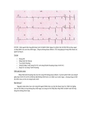 ECG30 : một người đàn ông 60t được xem là bệnh nhân ngoại trú phàn nàn về khó thở và đau ngực
có đặc điểm của cơn đau thắt ngực . Ông ta không được điềutrị. ECG này giúp gì trong chẩn đoán và
quản lý ông ta.
Trả lời
- Rung nhĩ
- Nhip thất 50-70ck/p
- Trục bình thường
- Sóng R thấp ( mất sóng R ở V3, với sóng R bình thường ở đạo trình V4 )
- Đoạn ST và sóng T bình thường
Diễn giải lâm sàng
Nhịp thất bình thường mặc dù cho rung nhĩ không được điềutrị. Sự kém phát triển của sóng R
giữa đạo trình V3 và V4 có thể do đặt không chính xác vị trí điện cực trước ngực , nhưng cũng có thể
do nhồi máu cơ tim cũ vùng trước vách.
Bạn làm gì ?
Nguyên nhân khác hơn của rung nhĩ ngoài thiếu máu cục bộ cần được loại trừ. Một test gắng
sức sẽ cho thấy có hay không đau thắt ngực và cũng sẽ cho thấy liệu nhịp thất có kiểm soát tốt hay
tăng lên không thích hợp.
 