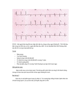 ECG32 : một người đàn ông 50t vào nhập viện cấp cứu, đang có đau ngực khoảng 4h . Tính chất đau
đặc trưng của nhồi máu cơ tim .ngoài dấu hiệu đau, kiểm tra các bộ phận khác bình thường. Điện
tâm đồ chỉ ra cái gì và bạn phải làm gì.
Trả lời
- Nhịp xoang
- Trục bình thường
- Sóng Q ở đạo trình DII,DIII,AVF
- ST chênh lên ở đạo trình DII,DIII,AVF và sóng T 2 pha
- ST chênh xuống ởAVL
- Phức bộ QRS ,đoạn ST và sóng T bình thường ở các đạo trình trước ngực
Diễn giải lâm sàng
Đây là nhồi máu cơ tim thành dưới. Tốc độ thay đổi phát triển của sóng Q rất nhanh chóng ,
nhưng nó hoàn toàn phù hơp với tiền sử đau ngực khoảng 4h trước .
Bạn làm gì ?
Giảm đau là một phần quan trọng của điều trị. Trừ trường hợp chống chỉ định, bệnh nhân nên
chỉ định dùng aspirin ,và sau đó là tiêu sợi huyết càng sớm có thể .
 