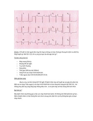 ECG33 : ECG ghi từ một người đàn ông 35t ông ta không có triệu chứng gì nhưng khi kiểm tra định kỳ
thấy huyết áp 180/105. ECG chỉ ra cái gì và bạn cần đê nghị làm gì ?
Trả lời ( chú ý test ½)
- Nhịp xoang 50ck/p
- Khoảng PR rất ngắn
- Trục bình thường
- Sóng delta
- Thời gian QRS kéo dài (200ms)
- Sóng R rất cao ở đạo trình thành bên
- T đảo ngược đạo trình DI,DII,DIII,AVF,V5,V6
Diễn giải lâm sàng
đây là ví dụ của hội chứng W-P-W typB. Ở bệnh nhân này với huyết áp cao gây nên phức bộ
QRS cao và sóng T đảo ngược ở các đạo trình thành bên sẽ làm tăng khả năng phì đại thất trái , mà
những thay đổi này cũng tổng hợp những điều trên , và nó phù hợp với hội chứng tiền kích thích.
Bạn làm gì ?
Nếu bệnh nhân này không gợi ý một cơn nhịp nhanh kịch phát, thì không cần thiết phải làm gì hơn .
Một số bệnh nhân có hội chứng tiền kích thích nhưng trên điện tim của họ không bao giờ có đoạn
nhịp nhanh.
 