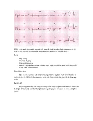 ECG34 : một người đàn ông 80t quan sát thấy sau phẫu thuật làm cầu nối đùi-khoeo chân đã ghi
nhận có một điện tâm đồ bất thường . Điện tâm đồ chỉ ra điều gì và bạn phải làm gì ?
Trả lời
- Nhịp xoang
- Trục bình thường
- Phức bộ QRS thường
- Đoạn ST chênh xuống đi ngang ( khoảng 8mm) ở đạo trình V2-V4 , và đi xuống dạng chếch
xuống ở đạo trình thành bên.
Diễn giải lâm sàng
Bệnh nhân là người cao tuổi có bệnh máu ngoại biên vì vậy bệnh mạch vành rất có thể có
mặt. Điện tâm đồ thể hiện thiếu máu cơ tim nặng . việc thiếu một cái nhịp nhanh là rất đáng ngạc
nhiên.
Bạn làm gì ?
Đây không phải là một tình trạng dễ quản lý vì tình trạng hậu phẫu bệnh nhân cần được quản
lý. Ông ta cần dùng một cách thận trọng thuốc kháng đông aspirin và heparin và nitrat đường tĩnh
mạch .
 