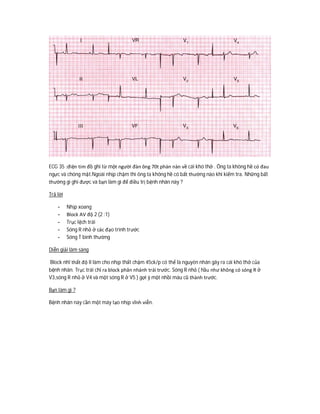 ECG 35 :điện tim đồ ghi từ một người đàn ông 70t phàn nàn về cái khó thở . Ông ta không hề có đau
ngực và chóng mặt.Ngoài nhịp chậm thì ông ta không hề có bất thường nào khi kiểm tra. Những bất
thường gì ghi được và bạn làm gì để điều trị bệnh nhân này ?
Trả lời
- Nhịp xoang
- Block AV độ 2 (2 :1)
- Trục lệch trái
- Sóng R nhỏ ở các đạo trình trước
- Sóng T bình thường
Diễn giải lâm sàng
Block nhĩ thất độ II làm cho nhịp thất chậm 45ck/p có thể là nguyên nhân gây ra cái khó thở của
bệnh nhân. Trục trái chỉ ra block phân nhánh trái trước. Sóng R nhỏ ( hầu như không có sóng R ở
V3,sóng R nhỏ ở V4 và một sóng R ở V5 ) gợi ý một nhồi máu cũ thành trước.
Bạn làm gì ?
Bệnh nhân này cần một máy tạo nhịp vĩnh viễn.
 