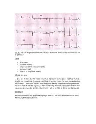 ECG 36 : điện tâm đồ ghi từ một sinh viên y khoa 20t khỏe mạnh . Anh ta lo lắng liệu mình có bị vấn
đề gì không ?
Trả lời
- Nhịp xoang
- Trục bình thường
- Sóng R cao (28mm ở V6 ,32mm ở V5 )
- Mất sóng R ở V3
- Đoạn ST và sóng T bình thường
Diễn giải lâm sàng
Điện tâm đồ chỉ ra dầy thất trái bởi ‘ tiêu chuẩn điện áp ‘( R lớn hơn 25mm ở V5 hoặc V6, hoặc
tổng R ở đạo trình V5 hoặc V6 cộng với S ở V1 hoặc V2 lớn hơn 35mm). Tuy nhiên không có sự thay
đổi của songsT . ‘ tiêu chuẩn điện áp ‘ đứng riêng chúng là không đáng tin cậy ,và trong một thanh
niên khỏa mạnh thì biến đổi này cũng có thể là bình thường . Mất sóng R ở V3 có thể chỉ điểm nhồi
máu cơ tim cũ , nhưng đây rất hiếm ở thanh niên trẻ tuổi nó có thể là do đặt sai vị trí điện cực V3 .
Bạn làm gì ?
Nói anh sinh viên mua một quyển sách hay về giải thích ECG, nếu chưa yên tâm thì siêu âm tim có
thể sử dụng để đo độ dày thất trái.
 