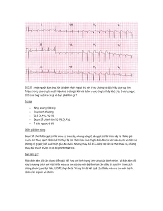 ECG37 : một người đàn ông 70t là bệnh nhân ngoại trú với triệu chứng và dấu hiệu của suy tim.
Triệu chứng của ông ta xuất hiện khá đột ngột khi vài tuần trước ông ta thấy khó chịu ở vùng ngực.
ECG của ông ta chira cái gì và bạn phải làm gì ?
Trả lời
- Nhịp xoang100ck/p
- Trục bình thường
- Q ở DI,AVL, V2-V5
- Doạn ST chênh lên V2-V6,DI,AVL
- T đảo ngược ở V6
Diễn giải lâm sàng
Đoạn ST chênh lên gợi ý nhồi máu cơ tim cấp, nhưng sóng Q sâu gợi ý nhồi máu xảy ra nhiều giờ
trước đó.Theo bệnh nhân kể thì thực tế cái nhồi máu của ông ta bắt đầu từ vài tuần trước và tiền sử
không có gì gợi ý nó xuất hiện gần đây hơn. Những thay đổi ECG có lẽ do tất cả nhồi máu cũ, những
thay đổi thành trước có lẽ do phình thất trái.
Bạn làm gì ?
Một điện tâm đồ cần được diễn giải kết hợp với tình trạng lâm sàng của bệnh nhân . Vì điện tâm đồ
này là tương thích với một nhồi máu cơ tim cũ cho nên bệnh nhân cần điều trị suy tim theo cách
thông thường với lợi tiểu, UCMC,chẹn beta. Vì suy tim là kết quả của thiếu máu cơ tim nên bệnh
nhân cần aspirin và statin.
 
