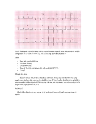 ECG45 : một người đàn bà 80t đang điều trị suy tim vài năm nay than phiền vì buồn nôn và ói mửa.
Không có sẵn hồ sơ bệnh án trước đây. ECG của bà giúp gì cho điều trị bà ta ?
Trả lời
- Rung nhĩ , nhịp thất 80ck/p
- Trục bình thường
- QRS bình thường
- Đoạn ST đi chênh xuống dạng dốc xuống, đặc biệt ở V4,V6
- Sóng T
Diễn giải lâm sàng
ECG chỉ ra rung nhĩ với tần số thất được kiểm soát. Không có gì trên điện tim này gợi ý
nguyên nhân của loạn nhịp hoặc suy tim của bệnh nhân. ST chênh xuống dạng lõm chén gợi ý bệnh
nhân đang điều trị bằng digoxin. ECG không cho thấy độc tính của digoxin,tuy nhiên nó rất có thể là
nguyên nhân gây buồn nôn cho bà ta.
Bạn làm gì ?
Điều trị bằng digoxin nên tạm ngưng, và bà ta nên định lượng kali huyết tương và nồng độ
digoxin.
 