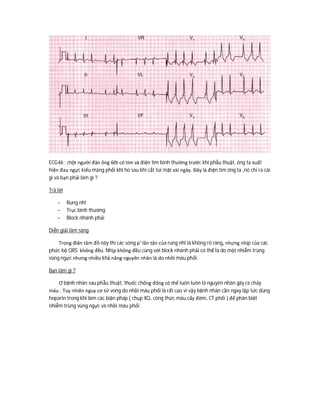 ECG46 : một người đàn ông 60t có tim và điện tim bình thường trước khi phẫu thuật, ông ta xuất
hiện đau ngực kiểu màng phổi khi ho sau khi cắt túi mật vài ngày. Đây là điện tim ông ta ,nó chỉ ra cái
gì và bạn phải làm gì ?
Trả lời
- Rung nhĩ
- Trục bình thường
- Block nhánh phải
Diễn giải lâm sàng
Trong điện tâm đồ này thì các sóng p’ lăn tăn của rung nhĩ là không rõ ràng, nhưng nhịp của các
phức bộ QRS không đều. Nhịp không đều cùng với block nhánh phải có thể là do một nhiễm trùng
vùng ngực nhưng nhiều khả năng nguyên nhân là do nhồi máu phổi.
Bạn làm gì ?
Ơ bệnh nhân sau phẫu thuật, thuốc chống đông có thể luôn luôn là nguyên nhân gây ra chảy
máu . Tuy nhiên nguy cơ tử vong do nhồi máu phổi là rất cao vì vậy bệnh nhân cần ngay lập tức dùng
heparin trong khi làm các biện pháp ( chụp XQ, công thức máu,cấy đờm, CT phổi ) để phân biệt
nhiễm trùng vùng ngực và nhồi máu phổi .
 