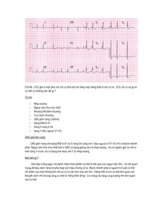 ECG48 : ECG ghi ở một phụ nữ 23t có thai đã tìm thấy một tiếng thổi ở tim cô ta . ECG chỉ ra cái gì và
có thể có những vấn đề gì ?
Trả lời
- Nhịp xoang
- Ngoại tâm thu trên thất
- Khoảng PR bình thường
- Trục bình thường
- QRS giãn rộng (160ms)
- Dạng RSR ở V1
- Sóng S rộng ở V6
- Sóng T đảo ngược V1-V3
Diễn giải lâm sàng
QRS giãn rộng với dạng RSR ở V1 và S rộng V6 cùng với T đảo ngược ở V1-V3 chỉ ra block nhánh
phải. Ngoại tâm thu trên thất bởi vì QRS có dạng giống như ở nhịp xoang , nó có nguồn gốc từ nhĩ vì
mỗi sóng T trước nó có dạng hơi khác với T từ nhịp xoang.
Bạn làm gì ?
Hồi hộp trống ngực mà bệnh nhân than phiền có thể là kết quả của ngoại tâm thu : nó rất quan
trọng để bảo đảm rằng nó phù hợp với triệu chứng cô ta. Block nhánh phải ở người trẻ tuổi có thể
chỉ điểm của một thông liên nhĩ và cô ta cần làm siêu âm tim. Tiếng thổi ở tim có thể liên quan với
khuyết vách nhĩ nhưng cũng có thể là ‘tiếng thổi dòng ‘ (cơ năng) do tăng cung lượng tim liên quan
với có thai.
 