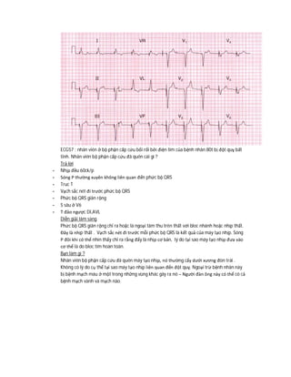 ECG57 : nhân viên ở bộ phận cấp cứu bối rối bởi điện tim của bệnh nhân 80t bị đột quỵ bất
tỉnh. Nhân viên bộ phận cấp cứu đã quên cái gì ?
Trả lời
- Nhịp đều 60ck/p
- Sóng P thường xuyên không liên quan đến phức bộ QRS
- Truc T
- Vạch sắc nét đi trước phức bộ QRS
- Phức bộ QRS giãn rộng
- S sâu ở V6
- T đảo ngược DI,AVL
Diễn giải lâm sàng
Phức bộ QRS giãn rộng chỉ ra hoặc là ngoại tâm thu trên thất với bloc nhánh hoặc nhịp thất.
Đây là nhịp thất . Vạch sắc nét đi trước mỗi phức bộ QRS là kết quả của máy tạo nhịp. Sóng
P đôi khi có thể nhìn thấy chỉ ra rằng đấy là nhịp cơ bản, lý do tại sao máy tạo nhịp đưa vào
cơ thể là do bloc tim hoàn toàn.
Bạn làm gì ?
Nhân viên bộ phận cấp cứu đã quên máy tạo nhịp, nó thường cấy dưới xương đòn trái .
Không có lý do cụ thể tại sao máy tạo nhịp liên quan đến đột quỵ. Ngoại trừ bệnh nhân này
bị bệnh mạch máu ở một trong những vùng khác gây ra nó – Người đàn ông này có thể có cả
bệnh mạch vành và mạch não.
 