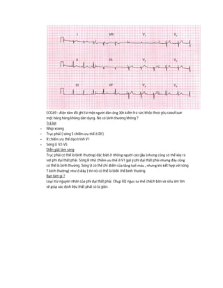 ECG69 : điện tâm đồ ghi từ một người đàn ông 30t kiểm tra sức khỏe theo yêu caaufcuar
một hãng hàng không dân dụng. Nó có bình thường không ?
Trả lời
- Nhịp xoang
- Trục phải ( sóng S chiếm ưu thế ở DI )
- R chiếm ưu thế đạo trình V1
- Sóng U V2-V5
Diễn giải lâm sàng
Trục phải có thể là bình thường( đặc biệt ở những người cao gầy )nhưng cũng có thể xảy ra
với phì đại thất phải. Sóng R nhỏ chiếm ưu thế ở V1 gợi ý phì đại thất phải nhưng đây cũng
có thể là bình thường. Sóng U có thể chỉ điểm của tăng kali máu , nhưng khi kết hợp với sóng
T bình thường( như ở đây ) thì nó có thể là biến thể bình thường.
Bạn làm gì ?
Loại trừ nguyên nhân của phì đại thất phải. Chụp XQ ngực tư thế chếch bên và siêu âm tim
sẽ giúp xác định liệu thất phải có bị giãn.
 
