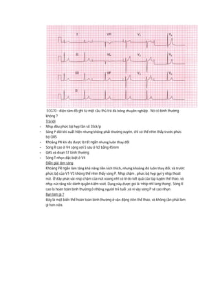 ECG70 : điện tâm đồ ghi từ một cầu thủ trẻ đá bóng chuyên nghiệp . Nó có bình thường
không ?
Trả lời
- Nhịp đều phức bộ hẹp tần số 35ck/p
- Sóng P đôi khi xuất hiện nhưng không phải thường xuyên, chỉ có thể nhìn thấy trước phức
bộ QRS
- Khoảng PR khi đo được là rất ngắn nhưng luôn thay đổi
- Sóng R cao ở V4 cộng với S sâu ở V2 bằng 45mm
- QRS và đoạn ST bình thường
- Sóng T nhọn đặc biệt ở V4
Diễn giải lâm sàng
Khoảng PR ngắn làm tăng khả năng tiền kích thích, nhưng khoảng đó luôn thay đổi, và trước
phức bộ của V1-V3 không thể nhìn thấy sóng P. Nhịp chậm , phức bộ hẹp gợi ý nhịp thoát
nút. Ở đây phát vài nhịp chậm của nút xoang nhĩ có lẽ do kết quả của tập luyện thể thao, và
nhịp nút tăng tốc dành quyền kiểm soát. Dạng này được goi là ‘nhip nhĩ lang thang’. Sóng R
cao là hoàn toàn bình thường ở những người trẻ tuổi ,và vì vậy sóng P sẽ cao nhọn.
Bạn làm gì ?
Đây là một biến thể hoàn toàn bình thường ở vận động viên thể thao, và không cần phải làm
gì hơn nữa.
 