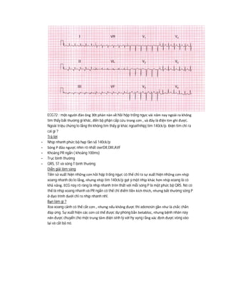 ECG72 : một người đàn ông 30t phàn nàn về hồi hộp trống ngực vài năm nay ngoài ra không
tìm thấy bất thường gì khác, đến bộ phận cấp cứu trong cơn , và đây là điện tim ghi được.
Ngoài triệu chứng lo lắng thì không tìm thấy gì khác ngoaifnhipj tim 140ck/p. Điện tim chỉ ra
cái gì ?
Trả lời
- Nhịp nhanh phức bộ hẹp tần số 140ck/p
- Sóng P đảo ngược nhìn rõ nhất owrDII,DIII,AVF
- Khoảng PR ngắn ( khoảng 100ms)
- Trục bình thường
- QRS, ST và sóng T bình thường
Diễn giải lâm sàng
Tiền sử xuất hiện những cơn hồi hộp trống ngực có thể chỉ ra sự xuất hiện những cơn nhịp
xoang nhanh do lo lắng, nhưng nhịp tim 140ck/p gợi ý một nhịp khác hơn nhịp xoang là có
khả năng. ECG này rõ ràng là nhịp nhanh trên thất với mỗi sóng P là một phức bộ QRS. Nó có
thể là nhịp xoang nhanh và PR ngắn có thể chỉ điểm tiền kích thích, nhưng bất thường sóng P
ở đạo trình dưới chỉ ra nhịp nhanh nhĩ.
Bạn làm gì ?
Xoa xoang cảnh có thể cắt cơn , nhưng nếu không được thì adenosin gần như là chắc chắn
đáp ứng. Sự xuất hiện các cơn có thể được dự phòng bằn betabloc, nhưng bệnh nhân này
nên được chuyển cho một trung tâm điện sinh lý với hy vọng rằng xác định được vòng vào
lại và cắt bỏ nó.
 