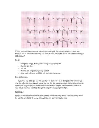 ECG79 : một phụ nữ lớn tuổi nhập viện trong tình trạng bất tỉnh, rõ ràng là bà ta có cái đột quỵ.
Không có vấn đề tim mạch bất thường nào được ghi nhận, nhưng đây là điên tim của bà ta. Những gì
đã bị bỏ qua ?
Trả lời
- Không thấy sóng p, đường cơ bản không đều gợi ý rung nhĩ
- Phức bộ QRS đều
- Trục trái
- Phức bộ QRS rộng có dạng không xác định
- Đứng trước mỗi phức bộ QRS là một vạch sâu nhọn và hẹp
Diễn giải lâm sàng
Vạch nhọn hẹp là kết quả của máy tạo nhịp , và nhân viên y tế đã không để ý thấy pin máy tạo
nhịp vĩnh viễn có lẽ được cấy dưỡi xương đòn trái. Dây dẫn nhịp sẽ kích thích thất phải làm cho phức
bộ QRS giãn rộng có dạng bloc nhánh. Nhịp cơ bản ở đây là rung nhĩ , bệnh nhân này có thể có cái
rung nhĩ với bloc hoàn toàn hoặc đơn giản là rung nhĩ với đáp ứng thất chậm.
Bạn làm gì ?
Đột quỵ có thể là do một thuyên tắc do huyết khối hình thành trong nhĩ trái kết quả của rung nhĩ. Có
thể tạo nhịp tạm thời bị lỗi nhưng đột quỵ không liên quan với máy tạo nhịp.
 