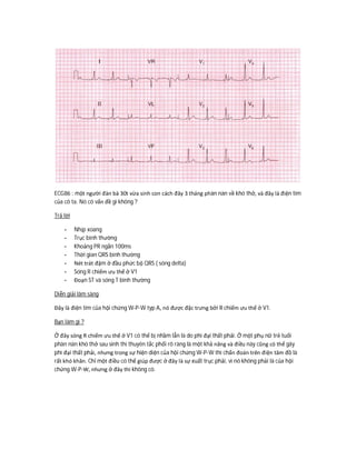 ECG86 : một người đàn bà 30t vừa sinh con cách đây 3 tháng phàn nàn về khó thở, và đây là điện tim
của cô ta. Nó có vấn đề gì không ?
Trả lời
- Nhịp xoang
- Trục bình thường
- Khoảng PR ngắn 100ms
- Thời gian QRS bình thường
- Nét trát đậm ở đầu phức bộ QRS ( sóng delta)
- Sóng R chiếm ưu thế ở V1
- Đoạn ST và sóng T bình thường
Diễn giải lâm sàng
Đây là điện tim của hội chứng W-P-W typ A, nó được đặc trưng bởi R chiếm ưu thế ở V1.
Bạn làm gì ?
Ở đây sóng R chiếm ưu thế ở V1 có thể bị nhầm lẫn là do phì đại thất phải. Ở một phụ nữ trẻ tuổi
phàn nàn khó thở sau sinh thì thuyên tắc phổi rõ ràng là một khả năng và điều này cũng có thể gây
phì đại thất phải, nhưng trong sự hiện diện của hội chứng W-P-W thì chẩn đoán trên điện tâm đồ là
rất khó khăn. Chỉ một điều có thể giúp được ở đây là sự xuất trục phải, vì nó không phải là của hội
chứng W-P-W, nhưng ở đây thì không có.
 