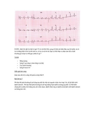 ECG90 : điện tim ghi từ một cô gái 17t có cái khó thở, sưng cổ chân,với dấu hiệu suy tim phải, và cô
ta có tiếng thổi ở tim từ khi sinh ra, cô ta có vẻ tím tái. Bạn có thể nhận ra điện tâm đồ có bất
thường gì và bạn có thể gợi ý điều trị gì ?
Trả lời
- Nhịp xoang
- Sóng P cao nhọn ( nhìn thấy rõ ở DII)
- Trục bình thường
- Sóng R trội ở V1
Diễn giải lâm sàng
Điện tâm đồ chỉ ra dày nhĩ phải và dày thất P.
Bạn làm gì ?
Phì đại nhĩ phải thường đi với tăng áp phổi do một vài nguyên nhân như hẹp 3 lá, dị tật bẩm sinh
bệnh ebstein . Phì đại thất phải thường đi với hẹp động mạch phổi và tăng áp phổi. Có thể kiểm
chúng tất cả điều trên bằng siêu âm chẩn đoán. Bệnh nhân này có bệnh dị tật bẩm sinh bệnh ebstain
và thông liên nhĩ .
 