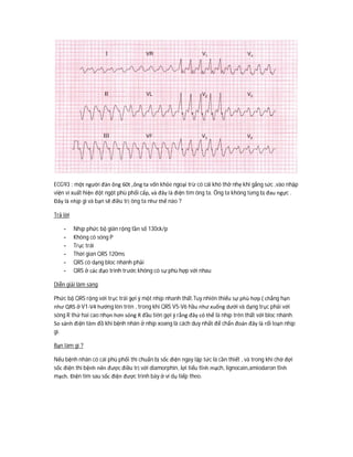 ECG93 : một người đàn ông 60t ,ông ta vốn khỏe ngoại trừ có cái khó thở nhẹ khi gắng sức ,vào nhập
viện vì xuất hiện đột ngột phù phổi cấp, và đây là điện tim ông ta. Ông ta không từng bị đau ngực .
Đây là nhịp gì và bạn sẽ điều trị ông ta như thế nào ?
Trả lời
- Nhịp phức bộ giãn rộng tần số 130ck/p
- Không có sóng P
- Trục trái
- Thời gian QRS 120ms
- QRS có dạng bloc nhánh phải
- QRS ở các đạo trình trước không có sự phù hợp với nhau
Diễn giải lâm sàng
Phức bộ QRS rộng với trục trái gợi ý một nhịp nhanh thất.Tuy nhiên thiếu sự phù hơp ( chẳng hạn
như QRS ở V1-V4 hướng lên trên , trong khi QRS V5-V6 hầu như xuống dưới và dạng trục phải với
sóng R thứ hai cao nhọn hơn sóng R đầu tiên gợi ý rằng đây có thể là nhịp trên thất với bloc nhánh.
So sánh điện tâm đồ khi bệnh nhân ở nhịp xoang là cách duy nhất để chẩn đoán đây là rối loạn nhịp
gì.
Bạn làm gì ?
Nếu bệnh nhân có cái phù phổi thì chuẩn bị sốc điện ngay lập tức là cần thiết , và trong khi chờ đợi
sốc điện thì bệnh nên được điều trị với diamorphin, lợi tiểu tĩnh mạch, lignocain,amiodaron tĩnh
mạch. Điện tim sau sốc điện được trình bày ở ví dụ tiếp theo.
 