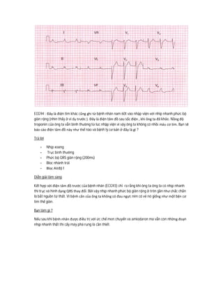 ECG94 : Đây là điện tim khác cũng ghi từ bệnh nhân nam 60t vào nhập viện với nhip nhanh phức bộ
giãn rộng (nhìn thấy ở ví dụ trước ). Đây là điện tâm đồ sau sốc điện , khi ông ta đã khỏe. Nồng độ
troponin của ông ta vẫn bình thường từ lúc nhập viện vì vậy ông ta không có nhồi máu cơ tim. Bạn sẽ
báo cáo điện tâm đồ này như thế nào và bệnh lý cơ bản ở đây là gì ?
Trả lời
- Nhịp xoang
- Trục bình thường
- Phức bộ QRS giãn rộng (200ms)
- Bloc nhánh trái
- Bloc AVđộ I
Diễn giải lâm sàng
Kết hợp với điện tâm đồ trước của bệnh nhân (ECG93) chỉ ra rằng khi ông ta ông ta có nhịp nhanh
thì trục và hình dạng QRS thay đổi. Bởi vậy nhịp nhanh phức bộ giãn rộng ở trên gần như chắc chắn
là bắt nguồn từ thất. Vì bệnh căn của ông ta không có đau ngực nên có vẻ nó giống như một bện cơ
tim thể giãn.
Bạn làm gì ?
Nếu sau khi bệnh nhân được điều trị với ức chế men chuyển và amiodaron mà vẫn còn những đoạn
nhịp nhanh thất thì cấy máy phá rung là cần thiết.
 