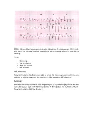 ECG95 : Điện tâm đồ ghi từ một người đàn ông 50t nhập viện sau 2h với cái đau ngực điển hình của
nhồi máu cơ tim. Sáu tháng trước điện tim đồ của ông ta là bình thường. Điện tim chỉ ra cái gì và bạn
sẽ làm gì ?
Trả lời
- Nhịp xoang
- Trục bình thường
- Ngoại tâm thu thất
- Bloc nhánh trái
Diễn giải lâm sàng
Ngoại tâm thu thất có thể dễ dàng nhận ra bởi nó có hình thái khác với dạng bloc nhánh trái và bởi vì
nó không có sóng P đi đằng trước. Bloc nhánh trái có thể là kết quả của nhồi máu cơ tim.
Bạn làm gì ?
Bloc nhánh trái rõ ràng là phát triển trong vòng 6 tháng trở lại đây và tiền sử gợi ý một cái nhồi máu
cơ tim. Dữ liệu cung cấp là bệnh nhân không có chống chỉ định việc dùng một yếu tố tiêu sợi huyết.
Ngoại tâm thu thất có thể không cần điều trị.
 