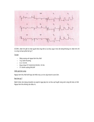 ECG98 : điện tim ghi từ một người đàn ông 50t có cái đau ngực mức độ nặng khoảng 1h. Điện tim chỉ
ra cái gì và bạn phải làm gì ?
Trả lời
- Nhịp xoang với ngoại tâm thu thất
- Trục bình thường
- Q ở V3-V5
- Đoạn đoạn ST chênh lên DI,AVL, V3-V6
- ST chênh xuống DIII,AVF
Diễn giải lâm sàng
Ngoại tâm thu thất kết hợp với nhồi máu cơ tim cấp thành trước bên.
Bạn làm gì ?
Bệnh nhân cần dùng morphin và aspirin ngay lập tức và tiêu sợi huyết càng sớm càng tốt nếu có thể.
Ngoại tâm thu không cần điều trị.
 