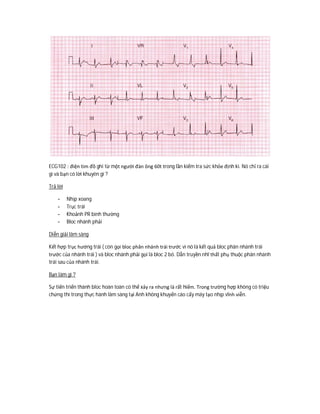 ECG102 : điện tim đồ ghi từ một người đàn ông 60t trong lần kiểm tra sức khỏe định kì. Nó chỉ ra cái
gì và bạn có lời khuyên gì ?
Trả lời
- Nhịp xoang
- Trục trái
- Khoảnh PR bình thường
- Bloc nhánh phải
Diễn giải lâm sàng
Kết hợp trục hướng trái ( còn gọi bloc phân nhánh trái trước vì nó là kết quả bloc phân nhánh trái
trước của nhánh trái ) và bloc nhánh phải gọi là bloc 2 bó. Dẫn truyền nhĩ thất phụ thuộc phân nhánh
trái sau của nhánh trái.
Bạn làm gì ?
Sự tiến triển thành bloc hoàn toàn có thể xảy ra nhưng là rất hiếm. Trong trường hợp không có triệu
chứng thì trong thực hành lâm sàng tại Anh không khuyến cáo cấy máy tạo nhịp vĩnh viễn.
 