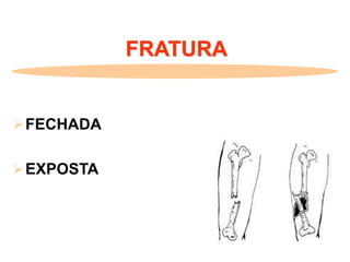 FRATURA
FECHADA
EXPOSTA
 